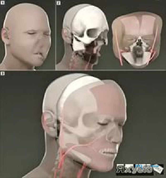 Facial first picture transplant