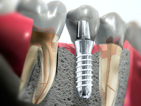 Хирургическая стоматология: самые востребованные процедуры width=