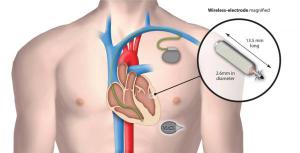 Разработчики компании EBR Systems представили беспроводной сердечный имплант Wise, размер которого не больше рисового зерна