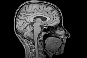 МРТ головы в СПБ, что показывает томография головы?