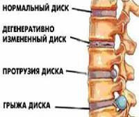 Материал для замены межпозвонковых дисков разработали ученые